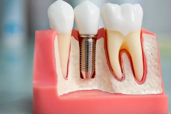 Mantenimiento de un implante dental 2026 Mantenimiento de un implante dental 2026