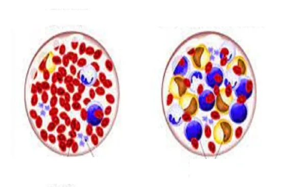 Leukemia treatment