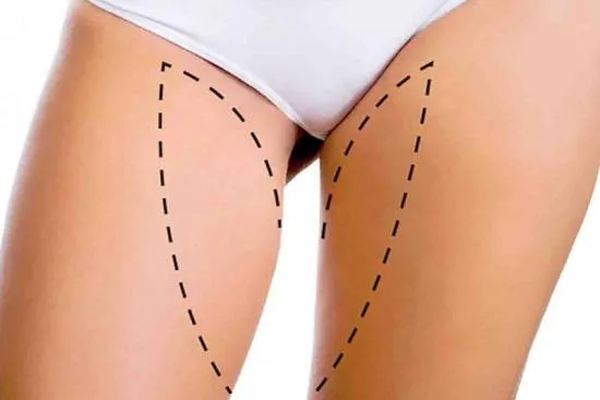 How is a thigh lift performed: step by step? 2026 How is a thigh lift performed: step by step? 2026