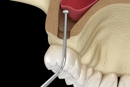 Maxillary sinus lift: What does it involve? 2026 Maxillary sinus lift: What does it involve? 2026