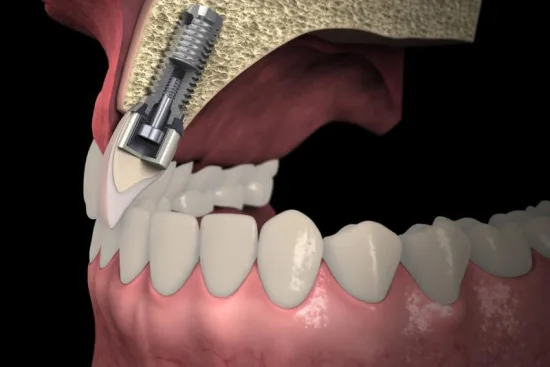 Sinus lift