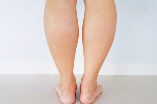 Calf reduction Calf reduction