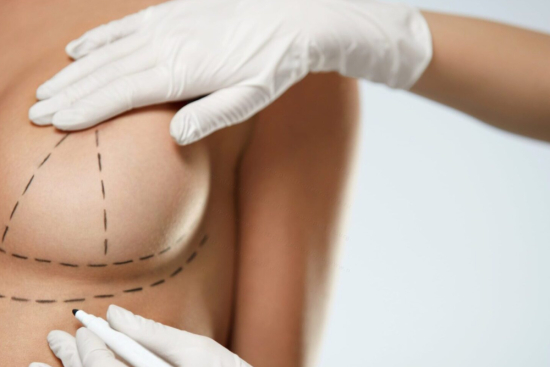 Nipple Cosmetic Surgery Nipple Cosmetic Surgery