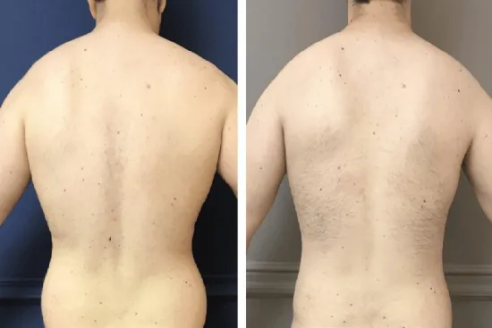 Hip liposuction in Turkey Hip liposuction in Turkey