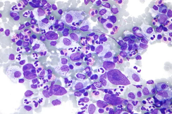Hodgkin's disease treatment