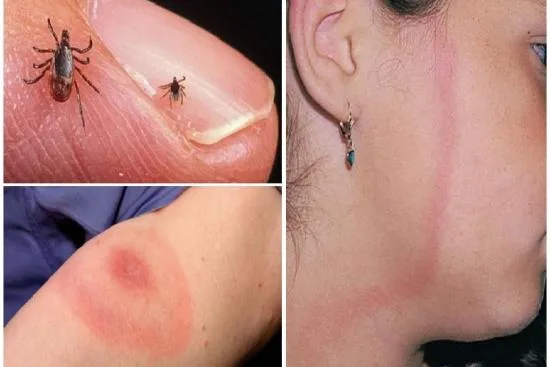 Diagnosis of Lyme disease 2026 Diagnosis of Lyme disease 2026