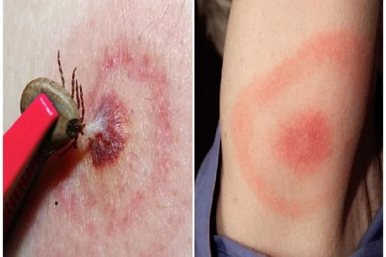 Treatment of Lyme borreliosis in Turkey 2026 Treatment of Lyme borreliosis in Turkey 2026