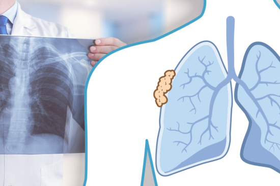 Pleural mesothelioma treatment