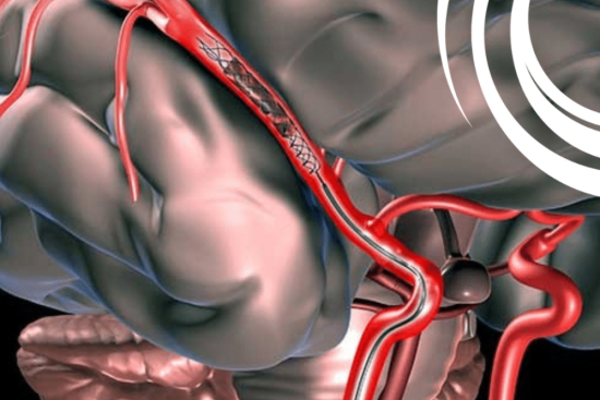 Mechanical thrombectomy