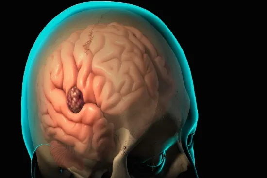 Meningioma Treatment