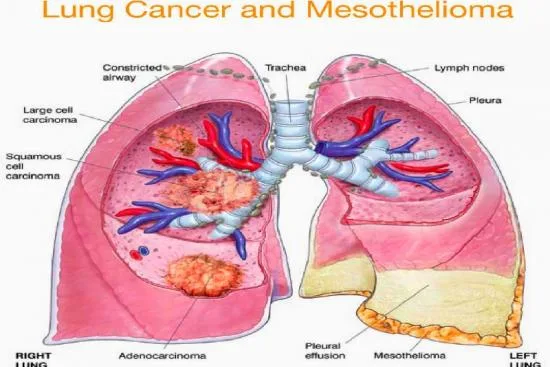 Opciones de tratamiento multimodal del mesotelioma pleural 2026 Opciones de tratamiento multimodal del mesotelioma pleural 2026