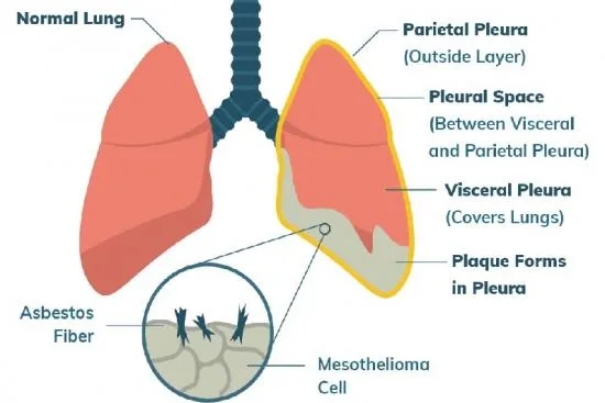 Mesotelioma pleural: visión general y contexto médico 2026 Mesotelioma pleural: visión general y contexto médico 2026