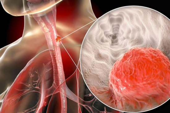 Esophageal cancer surgery