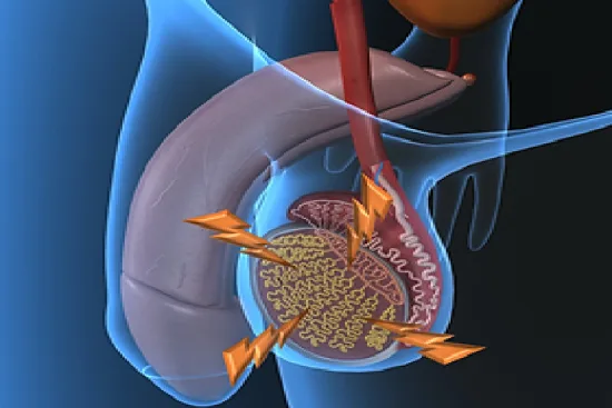 orchidectomy in Turkey Orchidectomy in Turkey