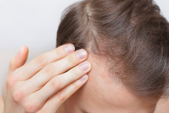 Hormonal hair loss treatment