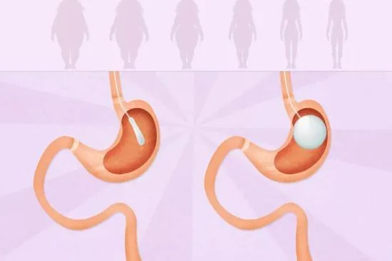 Gastric band in Turkey Gastric band in Turkey