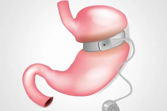 Gastric band surgery in Turkey Gastric band surgery in Turkey