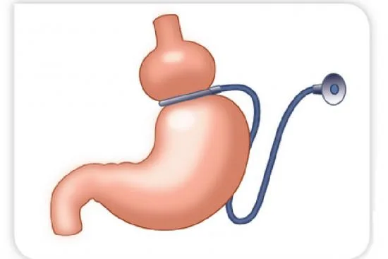 Gastric band in Turkey price Gastric band in Turkey price