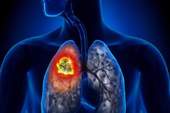 Lung cancer treatment