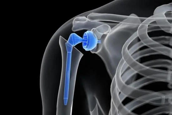 What is a shoulder prosthesis? 2026 What is a shoulder prosthesis? 2026