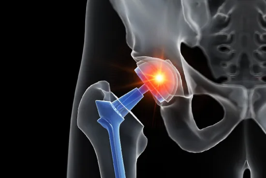 Técnica de nueva generación para colocar implantes de cadera 2026 Técnica de nueva generación para colocar implantes de cadera 2026