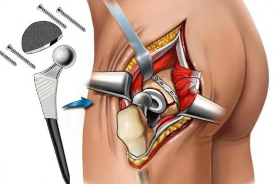 El proceso de implantación de prótesis de cadera en Turquía 2026 El proceso de implantación de prótesis de cadera en Turquía 2026