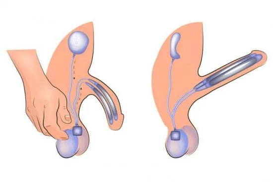 Penile implant Penile implant