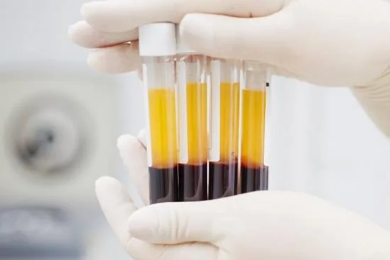 PRP treatment in Turkey PRP treatment in Turkey