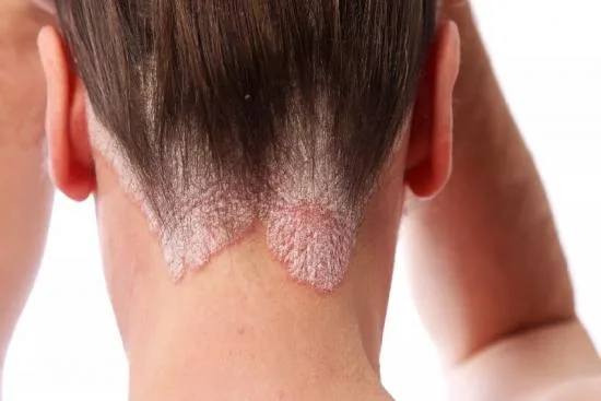 Psoriasis treatment in Turkey Psoriasis treatment in Turkey