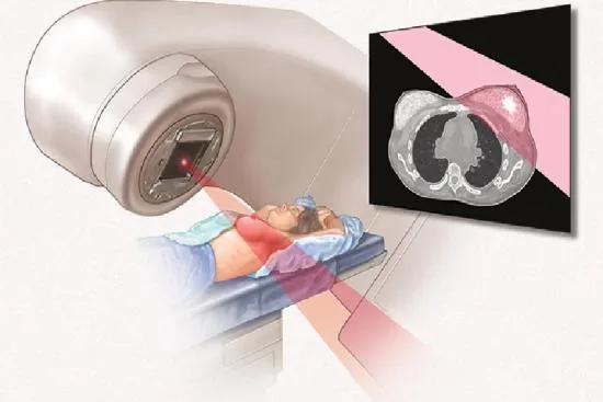 What are the different types of radiotherapy? 2026 What are the different types of radiotherapy? 2026