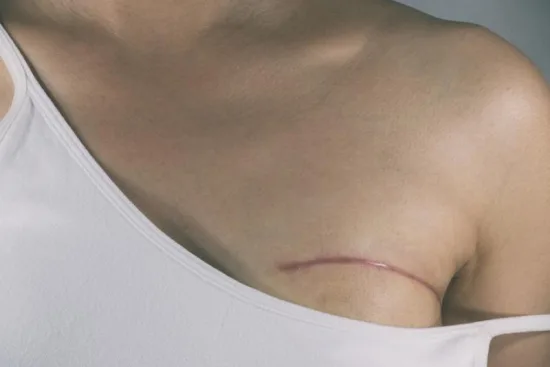Breast reconstruction Breast reconstruction