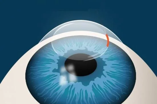 الفيمتو سمايل لتصحيح النظر الفيمتو سمايل لتصحيح النظر