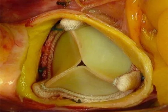 heart valves replacement heart valves replacement