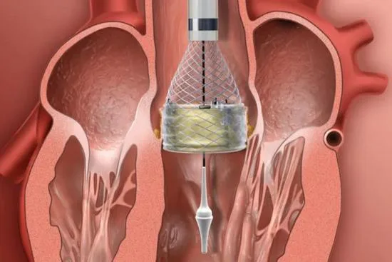 Remplacement valvulaire aortique par voie transcathéter (TAVI) 1 Remplacement valvulaire aortique par voie transcathéter (TAVI)