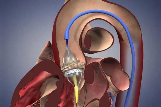 Remplacement valvulaire aortique par voie transcathéter (TAVI) 0 Remplacement valvulaire aortique par voie transcathéter (TAVI)