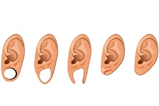 Indications for earring hole repair 2026 Indications for earring hole repair 2026