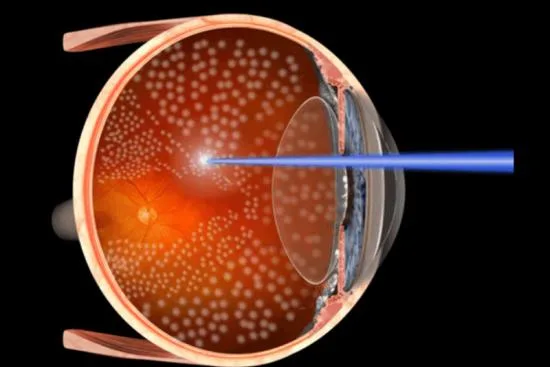 What is retinopathy of prematurity (ROP)? 2026 What is retinopathy of prematurity (ROP)? 2026