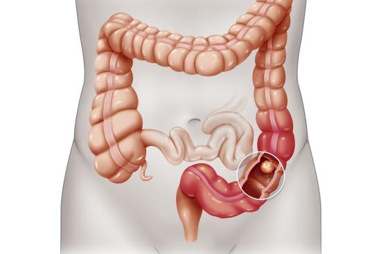 Bile duct cancer surgery
