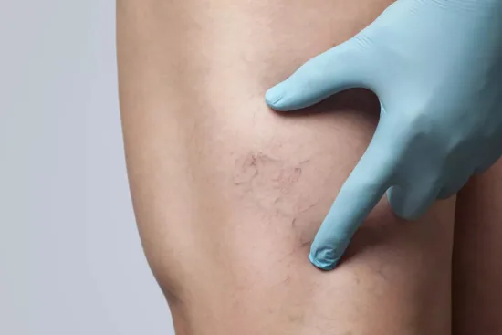 Varicose vein treatment Turkey Varicose vein treatment Turkey