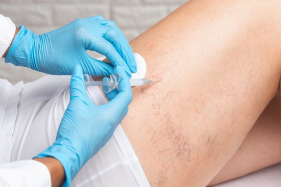 Sclerotherapy