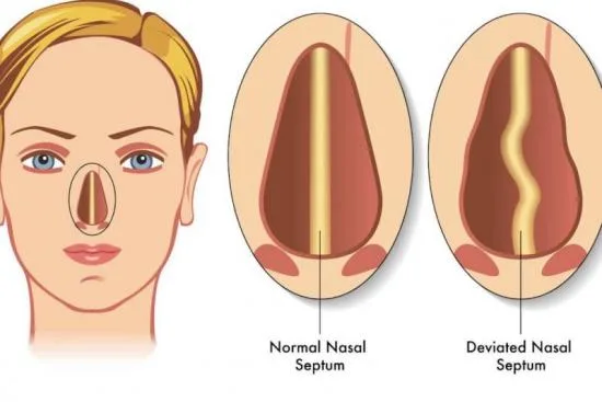 deviated septum surgery (septoplasty) deviated septum surgery (septoplasty)