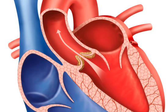 Aortic Valve Replacement Transcatheter (TAVI)