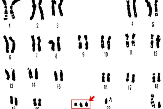 Down syndrome symptoms Down syndrome symptoms