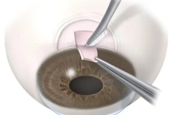 How a trabeculectomy is performed in Turkey? 2026 How a trabeculectomy is performed in Turkey? 2026