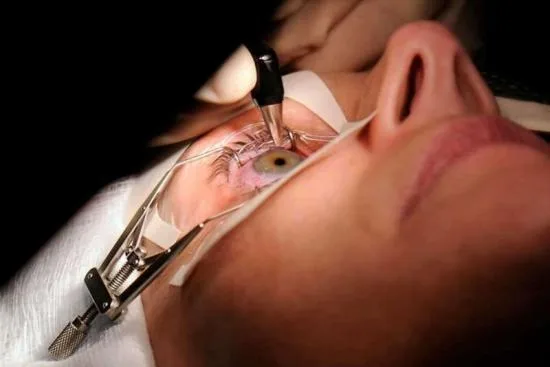 Why you might need a trabeculectomy? 2026 Why you might need a trabeculectomy? 2026