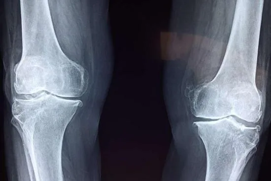Bone cancer treatment Bone cancer treatment