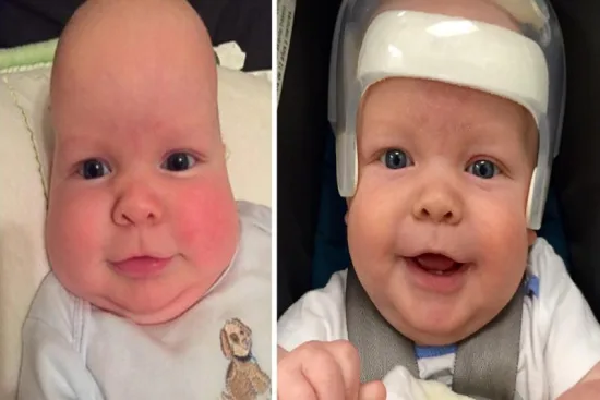 What is craniosynostosis? 2026 What is craniosynostosis? 2026