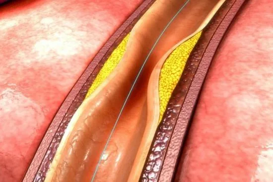 Arteriosclerosis obliterante: qué es realmente 2026 Arteriosclerosis obliterante: qué es realmente 2026