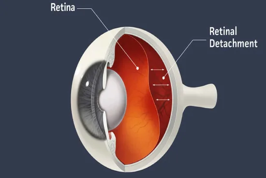 Retinal detachment Retinal detachment