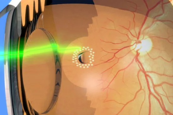 desprendimiento de retina desprendimiento de retina